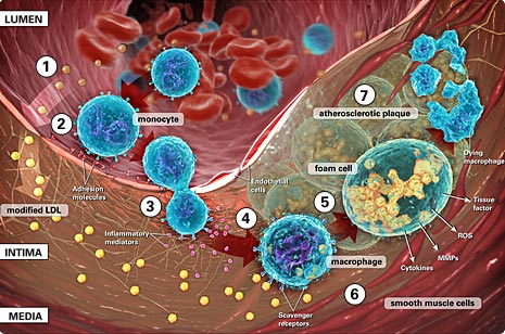 vascular_inflammation, LDL oxidization